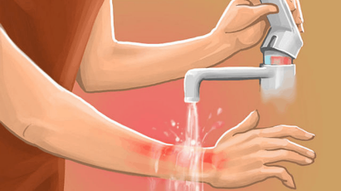 علاج للحروق طبيعي لا تستغني عنه