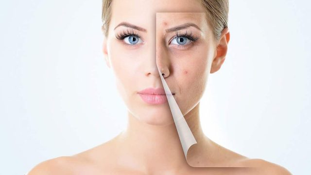 حلول جذرية لعلاج حب الشباب