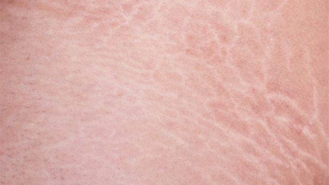 كيف تتخلصين من الخطوط البيضاء على الثدي؟