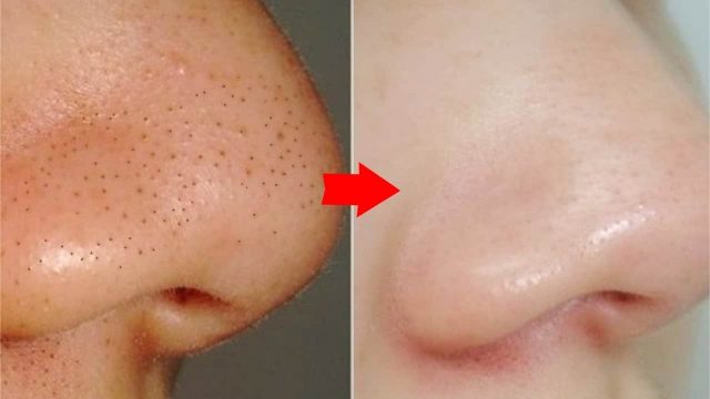 ماسكات طبيعية لإزالة الحبوب السوداء من البشرة