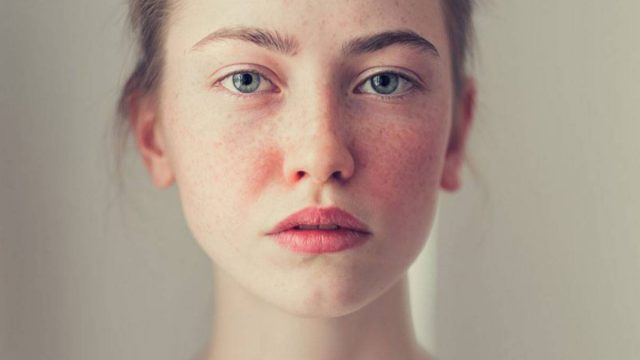 كل ما يجب أن تعرفيه عن البشرة الوردية