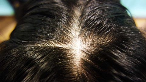 علاجات منزلية لحبوب فروة الرأس .. جربيها