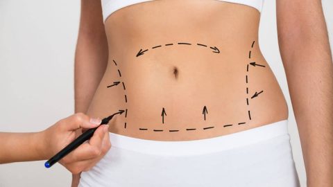 مضاعفات شفط الدهون الزائدة بالليزر.. اكتشفيها