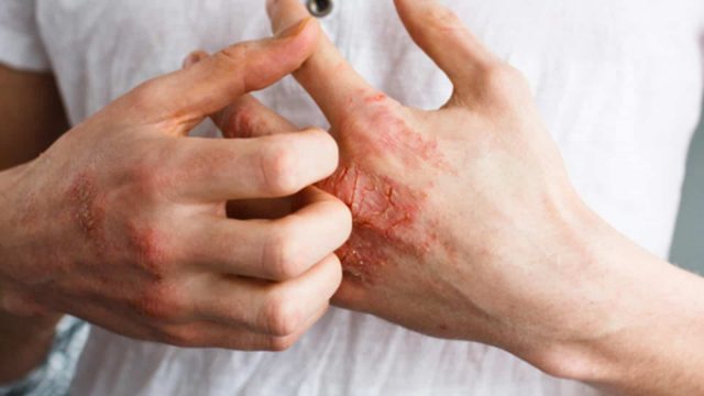 علاجات منزلية طبيعية للتخفيف من الإكزيما