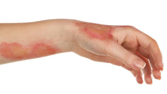 إليك الطريقة الصحيحة للتعامل مع الحروق