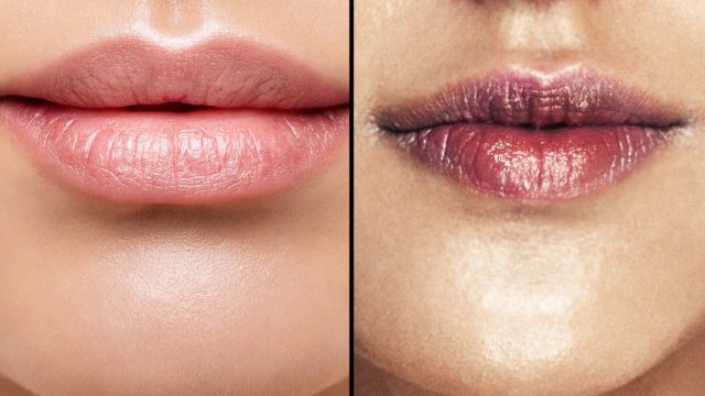 تغير لون الشفاه هل هو مشكلة جمالية أم صحية؟