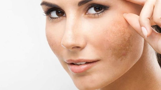 كلف البشرة وطرق علاجه والوقاية منه