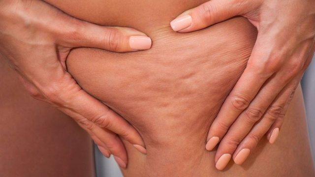 طرق مختلفة لعلاج السيلوليت وأهم أسبابه