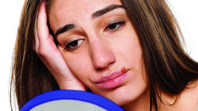 وصفات لعلاج القروح الباردة بمكونات تجدينها في مطبخك