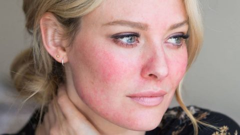 إليك أفضل النصائح لتهدئة البشرة الملتهبة بسرعة