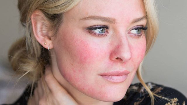 إليك أفضل النصائح لتهدئة البشرة الملتهبة بسرعة