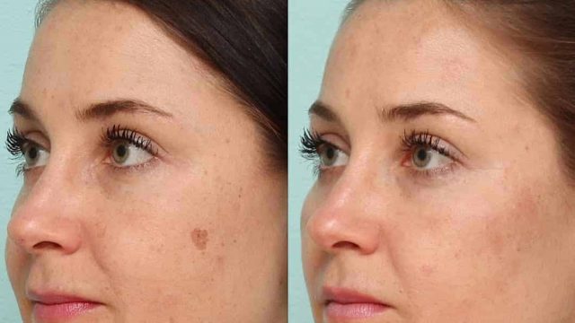 طرق طبيعية للتخلص من البقع على البشرة