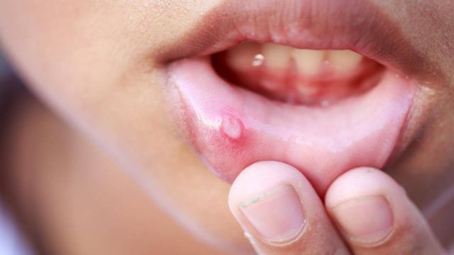 طرق التخلص من الهربس لدى الأطفال