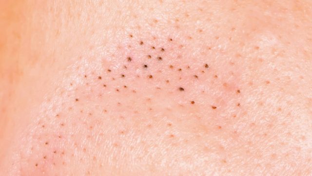 نصائح ووصفات للتعامل مع الرؤوس السوداء