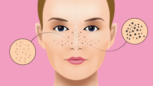 الطريقة المثالية لإزالة الرؤوس السوداء باستخدام الحلاوة