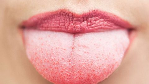 وصفات طبيعية لعلاج مشكلة اللسان الأبيض