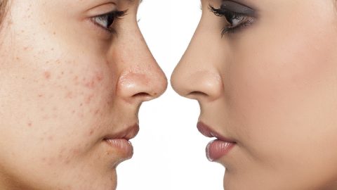 تقنية البي بي غلو : ما هي فوائدها وأضرارها لا تفوتي معرفتها