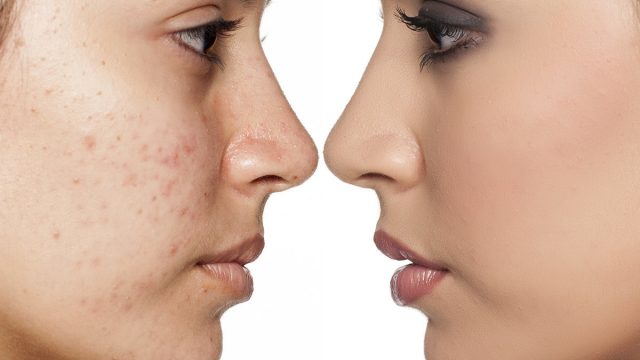 تقنية البي بي غلو : ما هي فوائدها وأضرارها لا تفوتي معرفتها