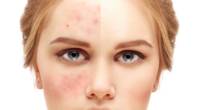 علاج حب الشباب : 8 خلطات سريعة سهلة ونتائجها سريعة