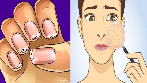 تعرفي إلى أهم أعراض نقص الكالسيوم من بينها تشقق الأظافر!