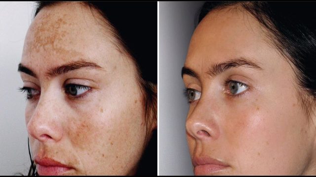 الكلف العميق : أسبابه وطرق العلاج لا تفوتي معرفتها الآن