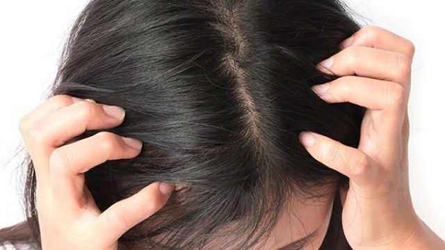 فروة الرأس الدهنية : علاجات منزلية جربيها قبل العيد