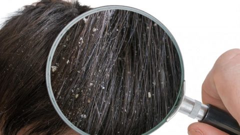 هل تصابين بقشرة الشعر مع تغير الفصول؟ إليك أفضل الحلول المنزلية