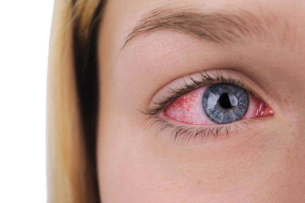 علاج جفاف العين
