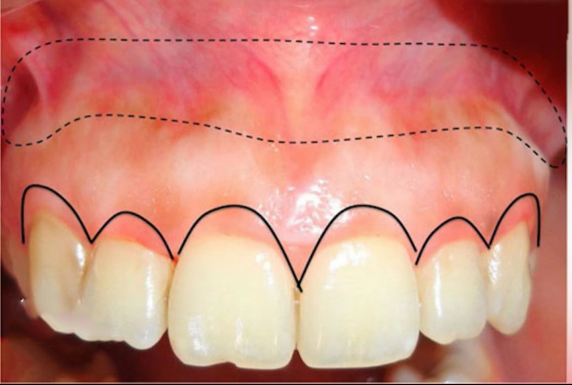 اسوداد اللثة