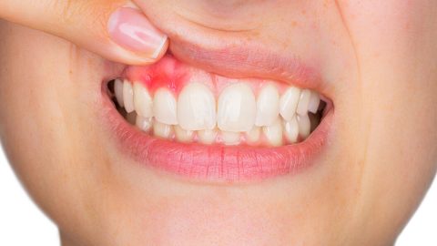 اسوداد اللثة : الأسباب والعلاجات