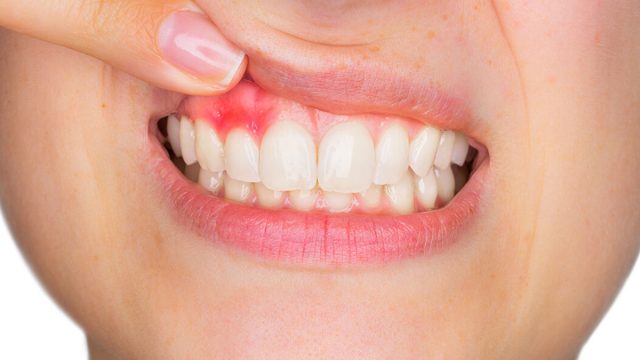 اسوداد اللثة : الأسباب والعلاجات