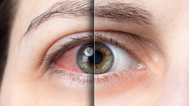 علاجات منزلية طبيعية لجفاف العينين