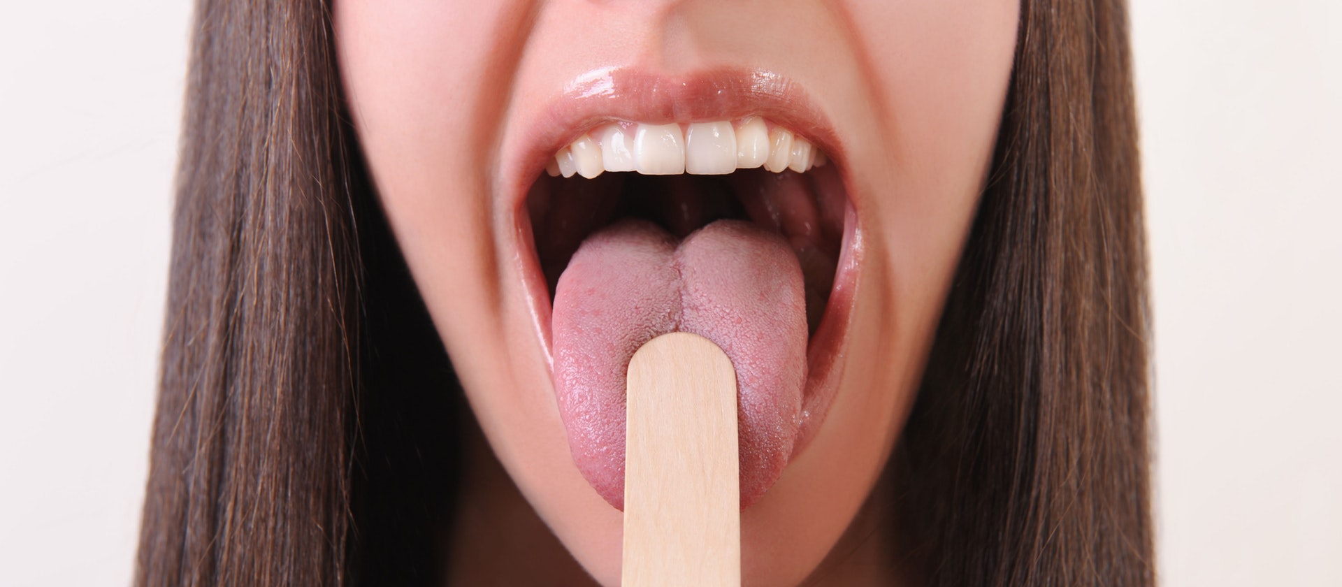  تقرحات اللسان