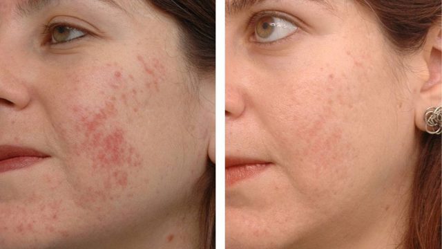 أسرع 3 خلطات للتخلص من آثار حب الشباب!