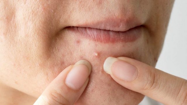 7 علاجات طبيعية للتخلص من حب الشباب وآثاره