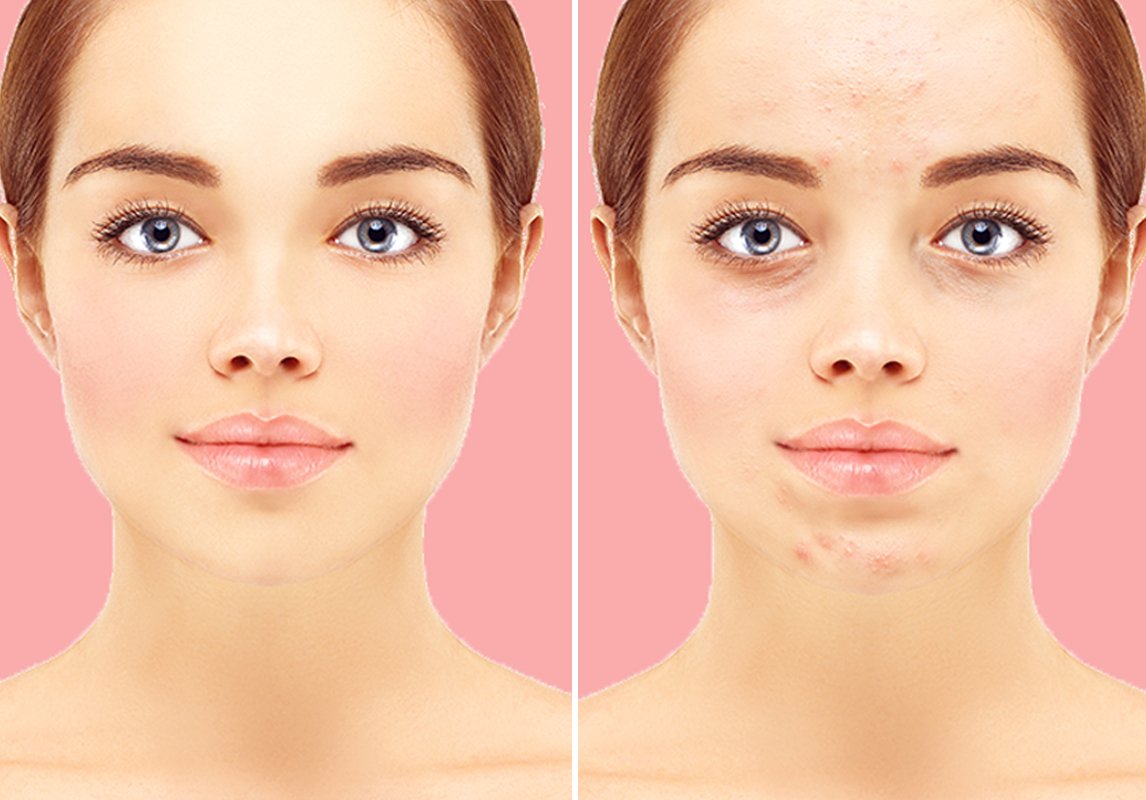 البشرة المختلطة