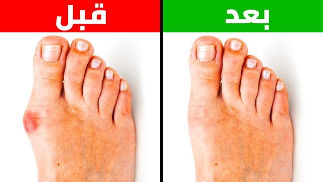 7 أطعمة يجب تجنبها لمرضى نقرس إبهام القدم