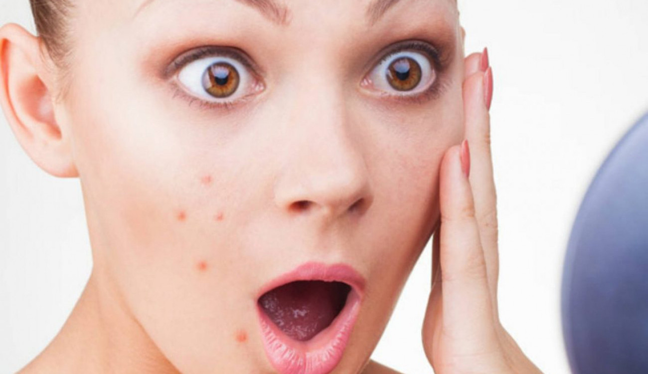 حب الشباب أثناء الحمل 