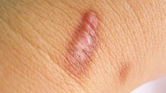 3 مواد طبيعية للتخلص من آثار الحروق البنية على البشرة