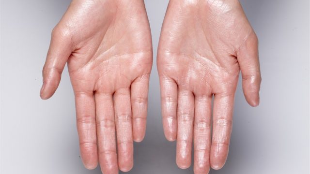 4 علاجات طبيعية لعلاج فرط تعرق اليدين والقدمين