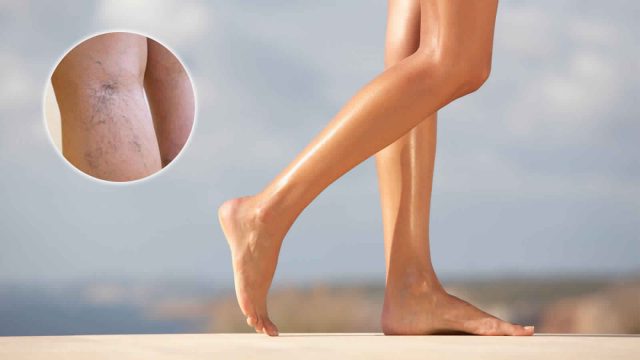 اكتشفي أفضل العلاجات المنزلية لدوالي الساقين!
