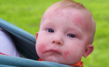 نصائح غذائية للطفل المصاب بالأكزيما