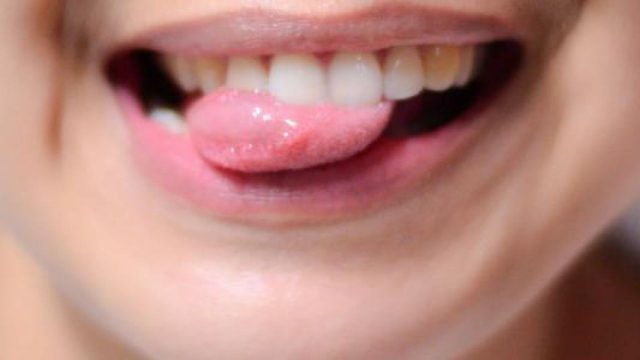 علاجات منزلية لتهدئة حروق اللسان