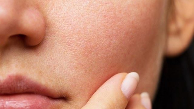 هل تعانين من حبوب تحت الجلد؟ إليك هذه العلاجات المنزلية!