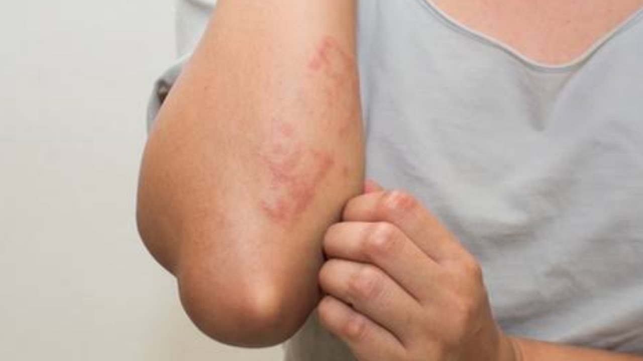 حساسية السمك