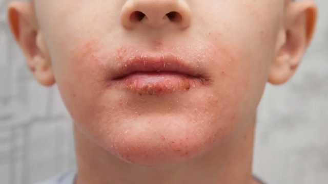 كل ما يجب أن تعرفيه عن علاج جفاف الجلد المحيط الفم