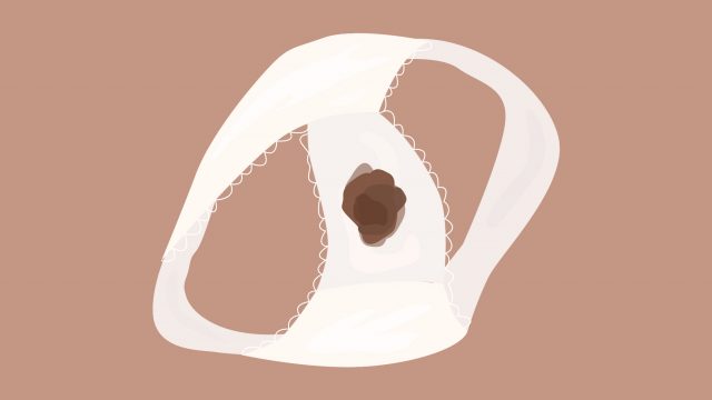 الإفرازات البنية خلال الأسابيع الأولى من الحمل ماذا تعني؟