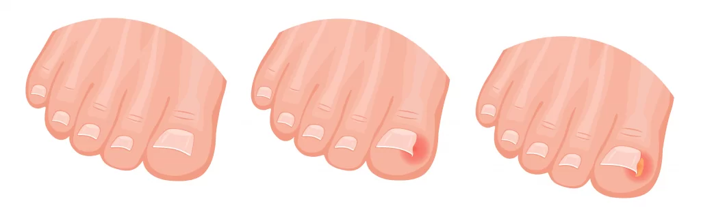 ظفر القدم الغارز