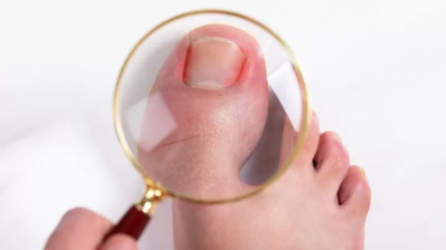 ظفر القدم الغارز في اللحم : الأعراض والأسباب