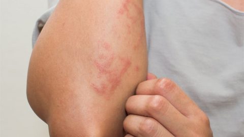 الطفح الجلدي الحراري : 3 علاجات منزلية تخلصك منه